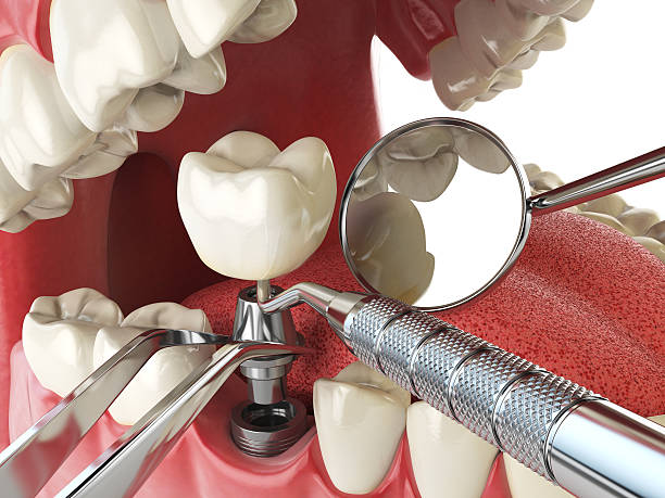 Best Emergency Tooth Extraction in Eldon, MO